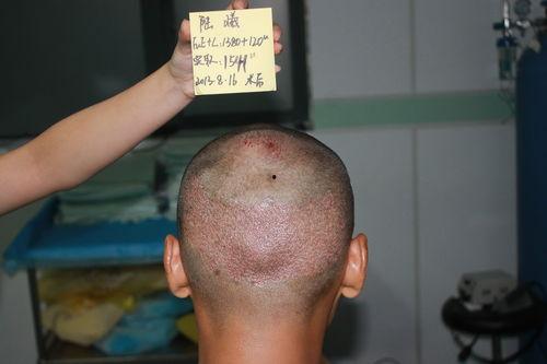 植发失败图片,揭秘术后常见问题与预防措施